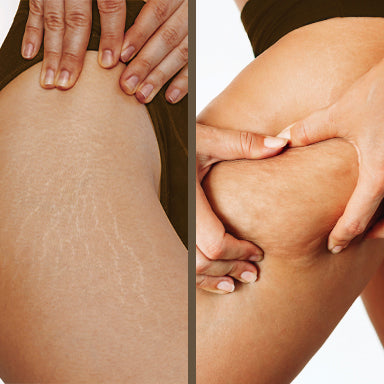 Cellulite and stretch marks - what's the difference?
